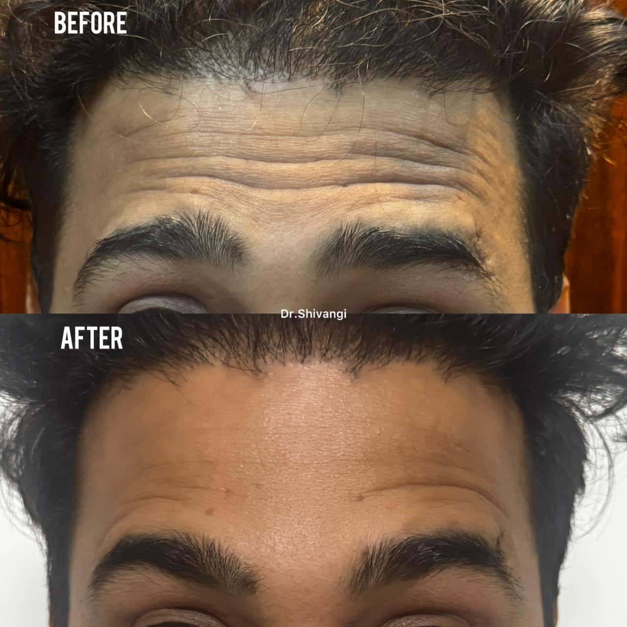 Botox Result 4
