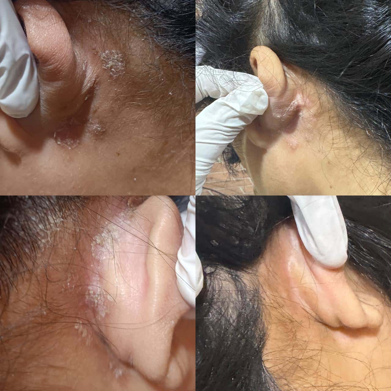 Botox Result 7